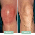 Nooro Knee Massager - Knee Pain Relief Device (nc)