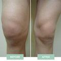 Nooro Knee Massager - Knee Pain Relief Device (nc)